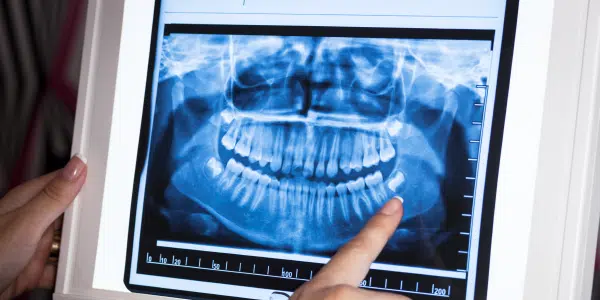 análise de raio-x odontológico